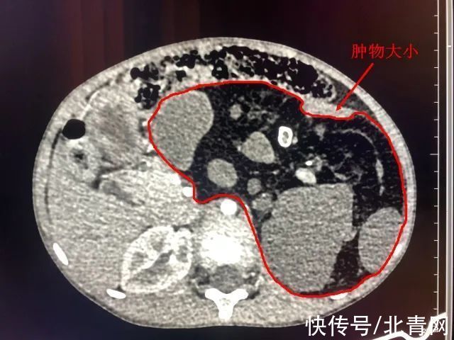 吴学东|到底怎么回事？大理6岁女孩肚里竟然藏着个“宝宝”