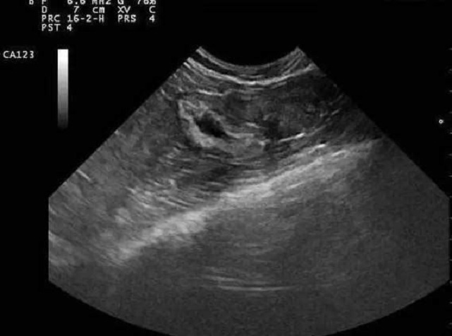 流产|女子怀孕3个月意外流产,清宫前发现子宫里一物,全家乐开花