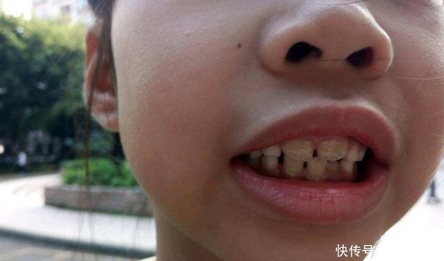 一起长大|7岁娃长出“双排牙”,奶奶的错误喂养方式要背锅,很多家长仍犯!