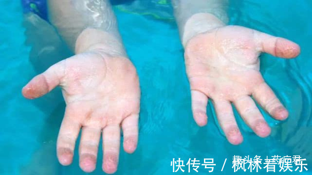 奇奇|男婴被100度开水烫伤后,妈妈做法遭全家反对,却得到医生点赞