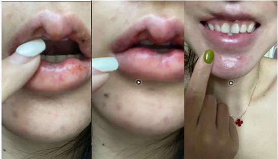 咨询师 医美整形失败,求退费 为何这么难?