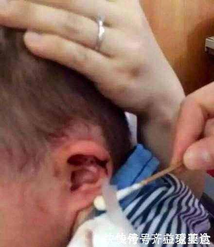 鸡皮疙瘩|7岁男童总说耳朵痒,妈妈用手电筒一看,身上的鸡皮疙瘩都起来了