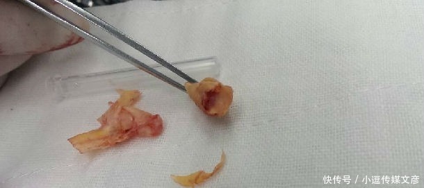 脖子上长了这个东西要当心!医生:多数脑梗都是因它而起!