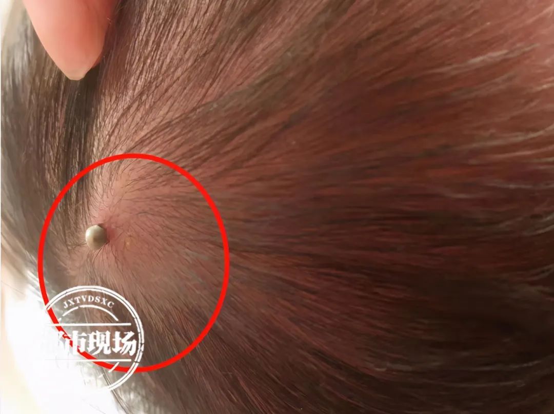 南昌|南昌一宝宝出生才4天，就被小虫咬了