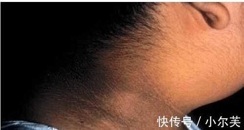 家长|9岁小女孩脖颈发黑洗不掉,经医院检查后,医生的话却让家长笑了