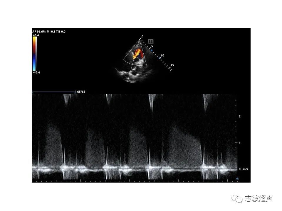 超声|肺动脉瓣周边异常血流的超声鉴别