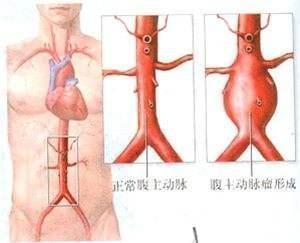 甲亢|大病来临前，身体会出现3个征兆！经常对照，及时预防
