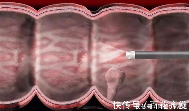 信号|患上大肠癌的第一个信号，常常是这种异常，最好去检查一下