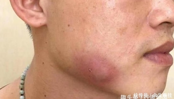 小李|小伙几年不刷牙脸发肿,张开嘴后医生却想吐:这是什么味儿!