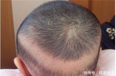 补钙|宝宝枕秃不要盲目补钙,首先你得搞清楚是生理性的还是病理性的?