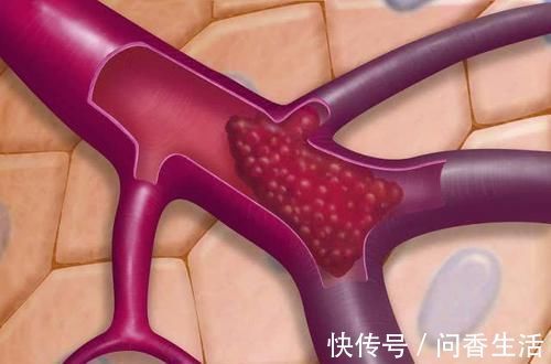 疏通血管|天然的“血管清道夫”, 每天吃一些, 助你疏通血管, 让血液更干净