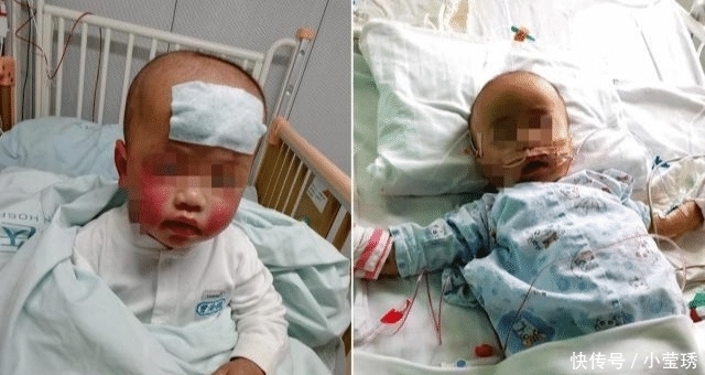 男婴脸上长了一个红疙瘩，后被切除半张脸，10天后又确诊癌症