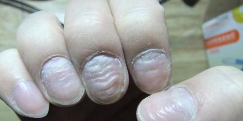 黄大姐|55岁河北大姐肝病晚期,医生惋惜:身体早有症状,只怪她没当回事