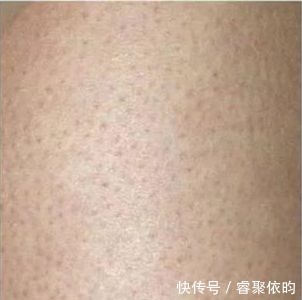 水杨酸|闭口、黑头、痘痘、脂肪粒……终于分清它们是什么了