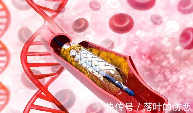 心梗|同是冠心病,一个长期吃药一个放了支架,十年后命运截然不同