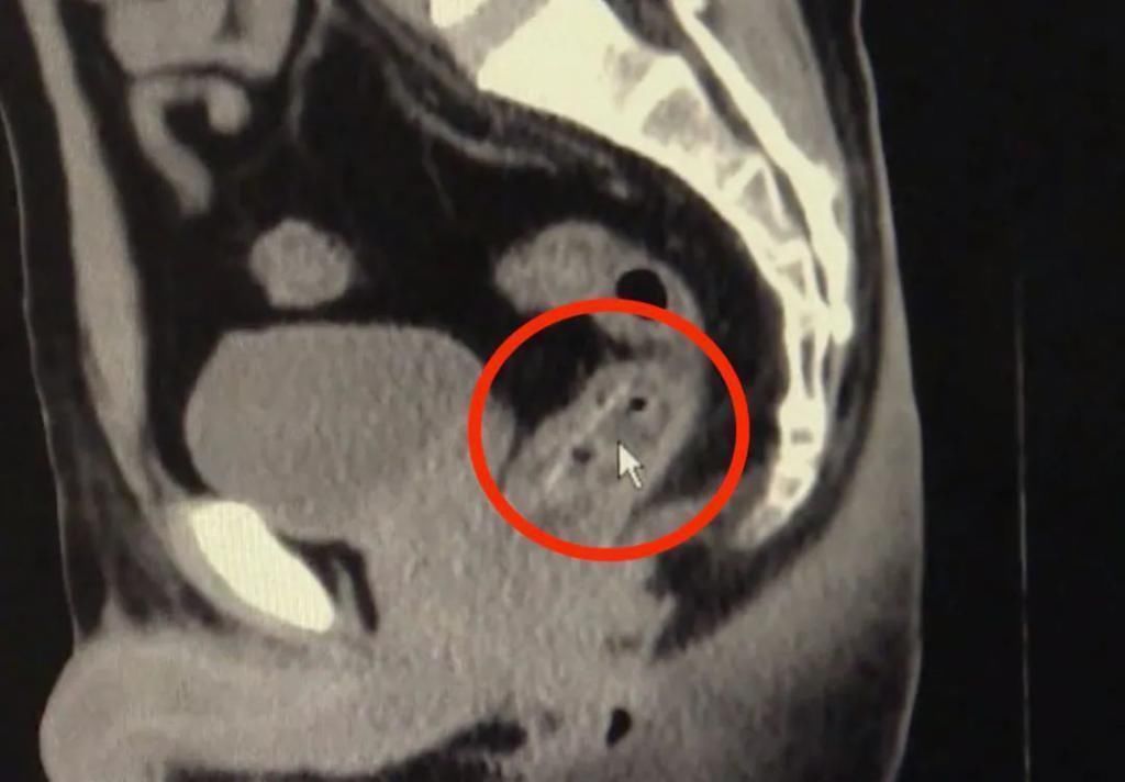 直肠腔|男子长“痔疮”疼痛难忍,万万没想到是它卡在肛门!