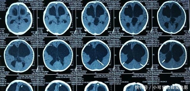 宝出生以后|囟门闭合的时间,对大脑发育有什么影响如果是第三种就该注意了