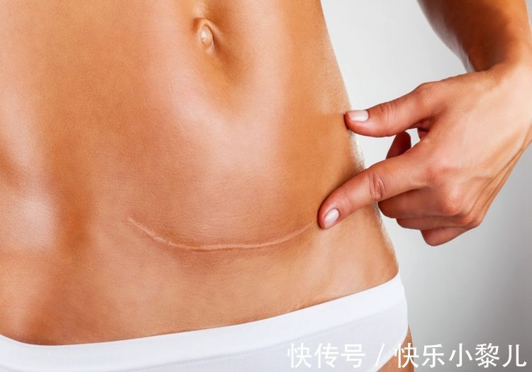 切口|剖腹产横切和纵切有什么区别?打算剖腹产的孕妇,要认真做选择