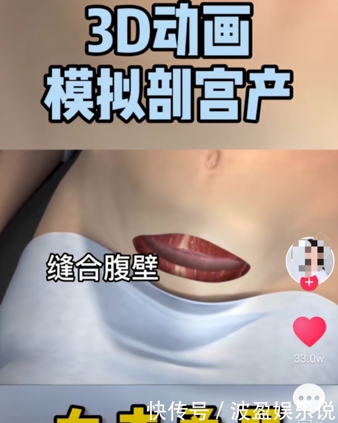 麻醉|剖宫产有多“伤”妈妈，几张3D过程图带你了解，感恩老婆和妈妈