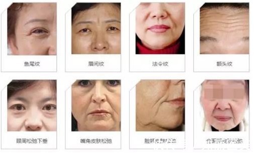 smas 现在拉皮手术的名字那么多,大拉皮、小拉皮、到底应该怎么选?