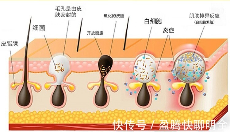饮食习惯|男士护肤:皮肤长痘应该怎么护肤?