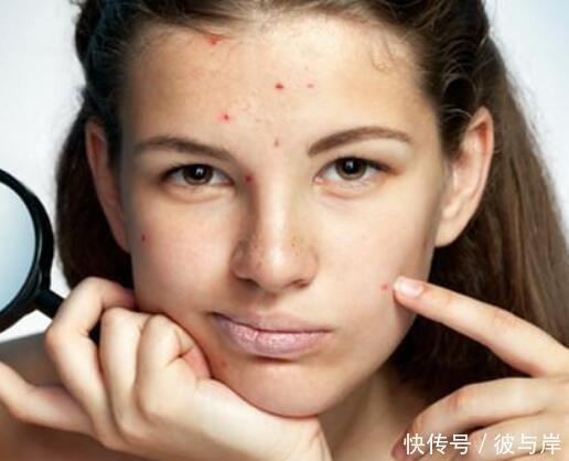 祛痘印方法用不对可能伤害皮肤!做到4点,更科学的祛痘印