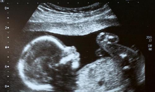 b超|每次产检结果正常,孩子生出后发现畸形,医院需要负责吗?