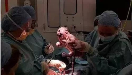 养胎|超预产期5周，准妈还在家“待产养胎”，取出孩子后医生无奈摇头