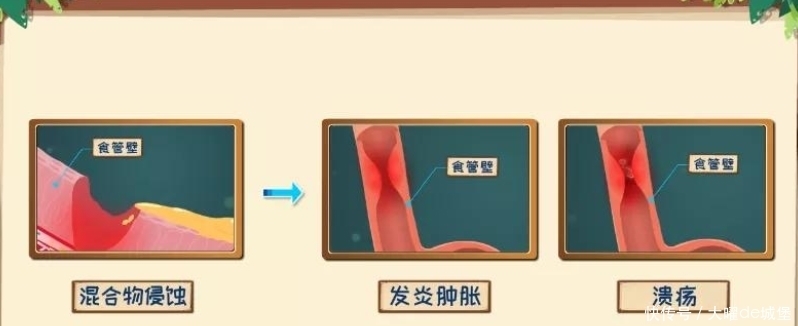 胃食管反流咋回事?反酸烧心背后真相是啥?胃食管反流发病机制