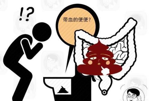  患者|排便若有这5种表现，多半是肠癌发出的求救信号，趁早进行检查