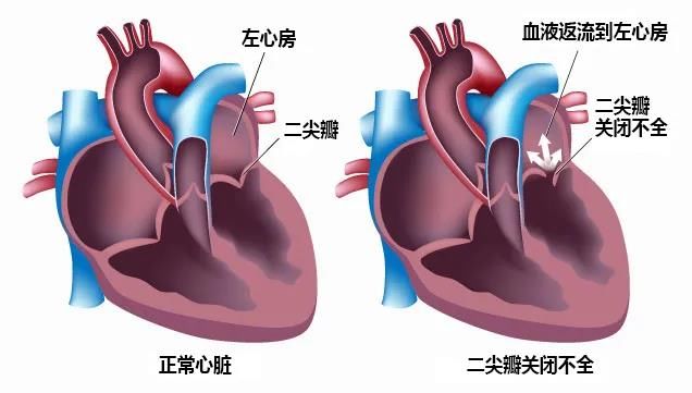 左心房|【健哥说心脏】给心脏修阀门——二尖瓣成形术