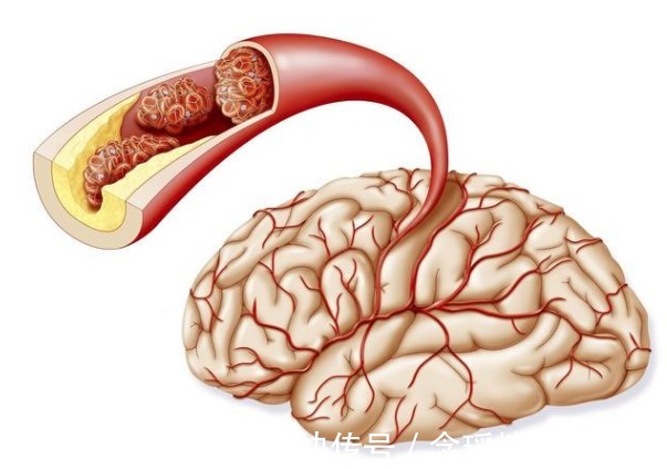颈动脉狭窄|颈动脉出现硬化斑块,必须吃他汀和阿司匹林?本文辟谣讲出实情
