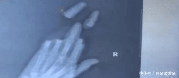 大风刮过,男子手掌还在,4指“不翼而飞”!