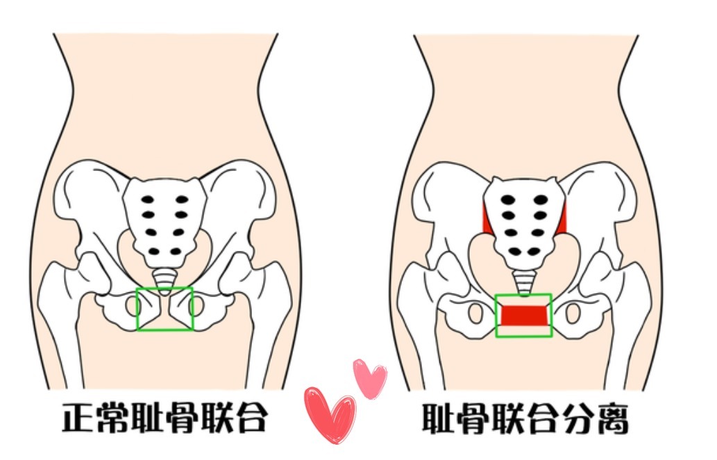 骨盆|准妈妈耻骨疼得越早,娃生的就越快生宝宝快的孕妈有这三大特征