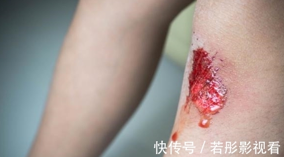 高血脂|血脂高不高,看脚就知道,若没有这4种症状,恭喜,血管还算通畅