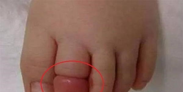 脚趾|11月龄宝宝脚趾进“虫”，家长紧急送医，医生直言幸好来得早