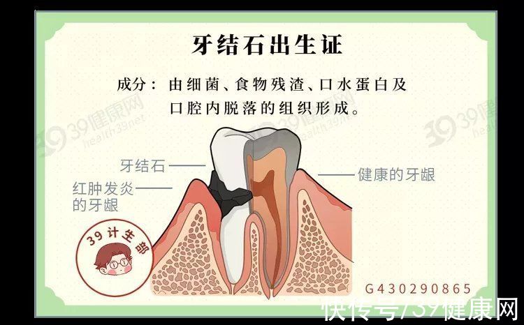 牙结石牙结石|牙齿上的“小石头”，怎么去除好得快？真正有用的方法是这2个