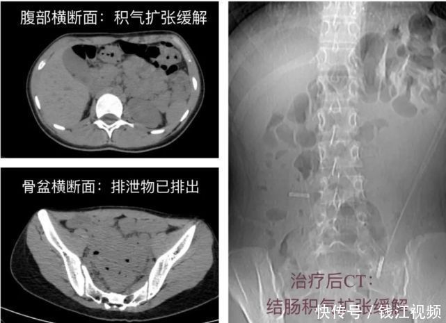 高中生|高中生女孩长期便秘,子宫竟被挤偏!治疗后,她一夜“轻了”8斤