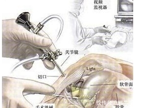 骨科医生：5种骨折不归骨科管！看病别再走错了