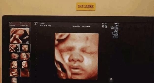 四维彩超|怀孕之后,孕妈做四维前要清楚的3件事,不然可能会白白浪费钱