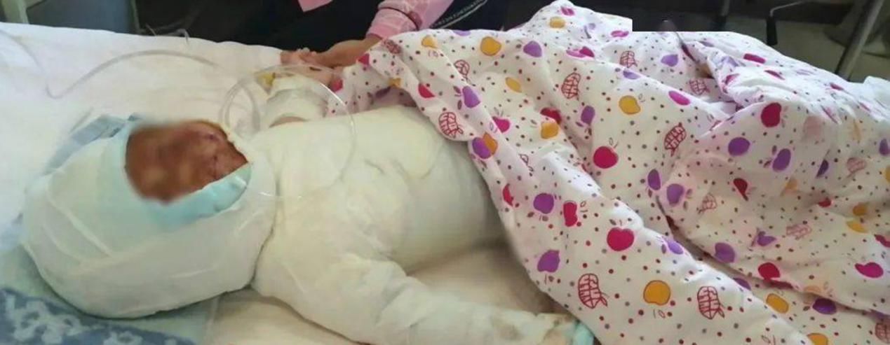 开水|哈市11个月大男婴，被开水从头浇到脚 孩子妈妈：早已皮开肉绽