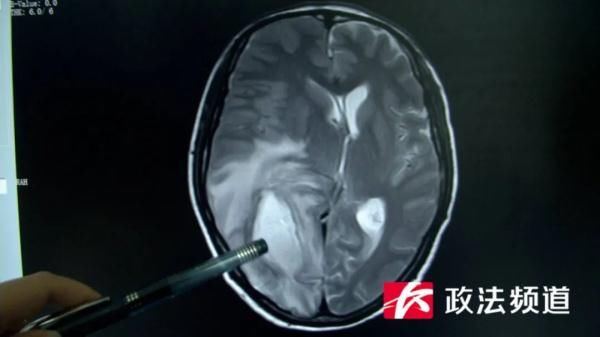 男子|挤了一颗痘痘，男子竟住进ICU！