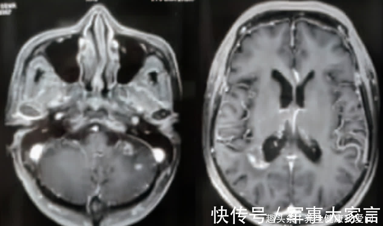 李明|打破肺癌晚期最多存活半年“魔咒”,晚期癌症带瘤生存4年病例