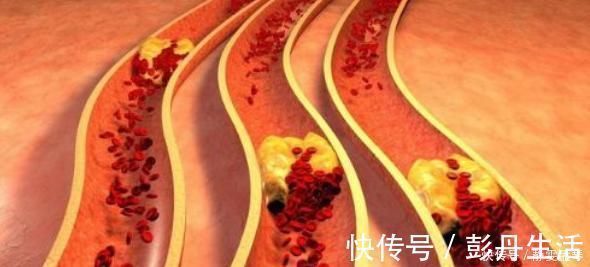 保健品|喝什么可以预防高血压,高血脂,软化血管?今天来告诉你真相!