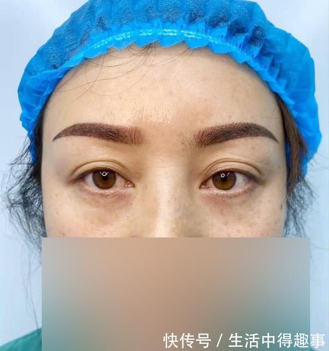 眼周 亲身经历眼周年轻化,来看看49岁女士眼周年轻化术前术后对比!