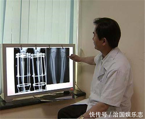 为了长高7厘米,花了16万去断骨增高的李亚诺,如今双腿彻底废了