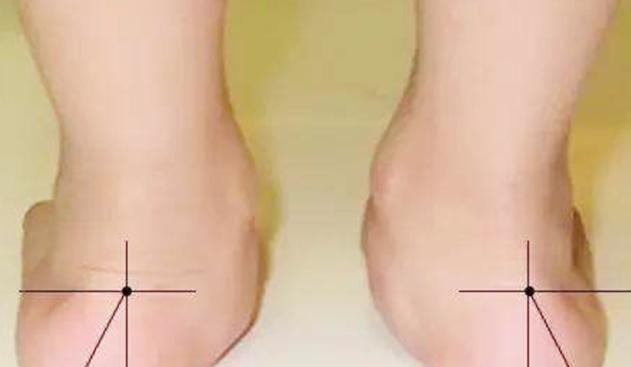 双脚|6岁孩子双脚变“畸形”,只因妈妈错误穿鞋方式,家长要引起重视