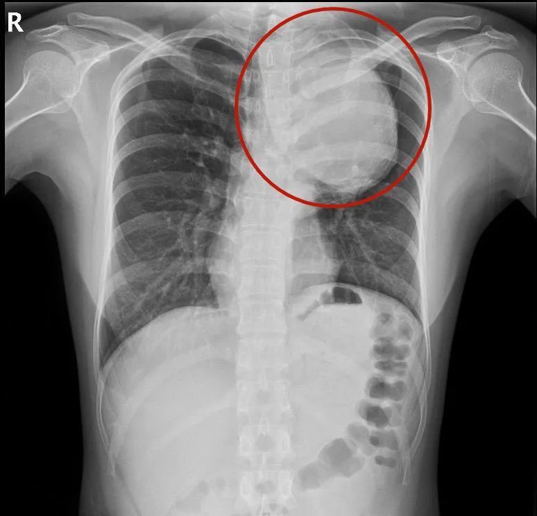 深圳医院|女子身体藏了一个“不定时炸弹”!吵架生气可能就引爆