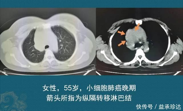 放化疗|查出癌症不放疗不化疗，保持良好心态吃喝玩乐，能扛过去吗