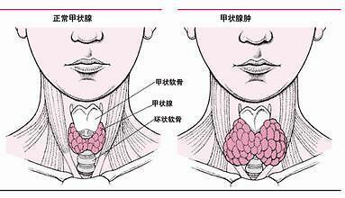 甲状腺|甲状腺结节是“吃”出来的？